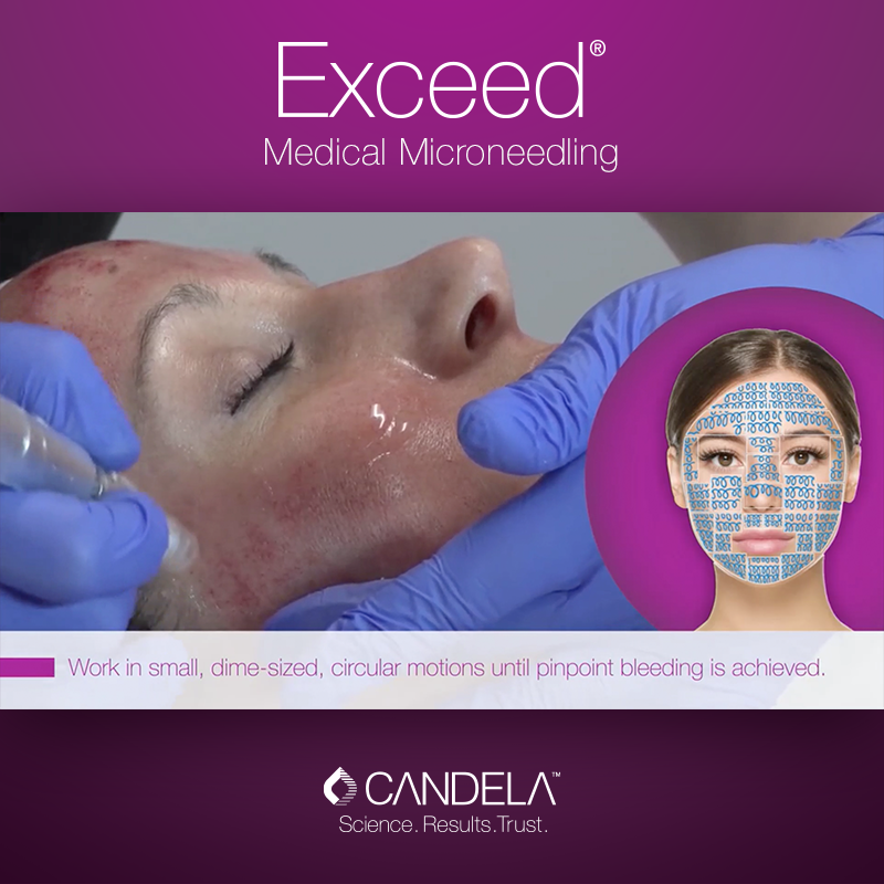 Performing an Exceed™ medical microneedling treatment 